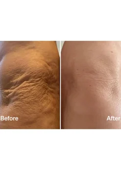 Laser Mist & Glide Refill 60 Days
