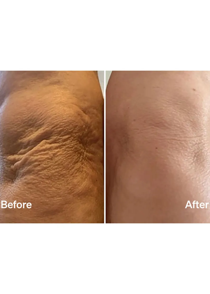 Laser Mist & Glide Refill 30 Days