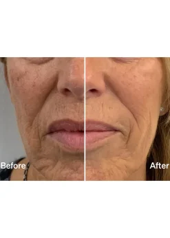 Laser Mist & Glide Refill 30 Days