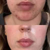 Red Peel Breakout Control Mask