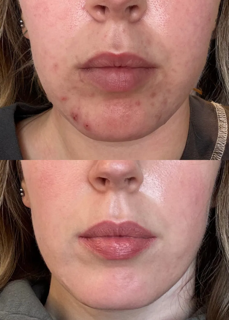 Red Peel Breakout Control Mask