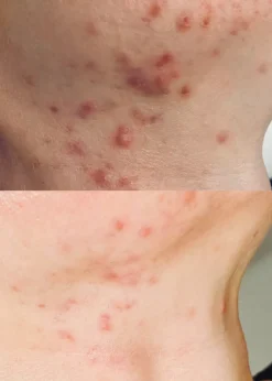 Red Peel Breakout Control Mask