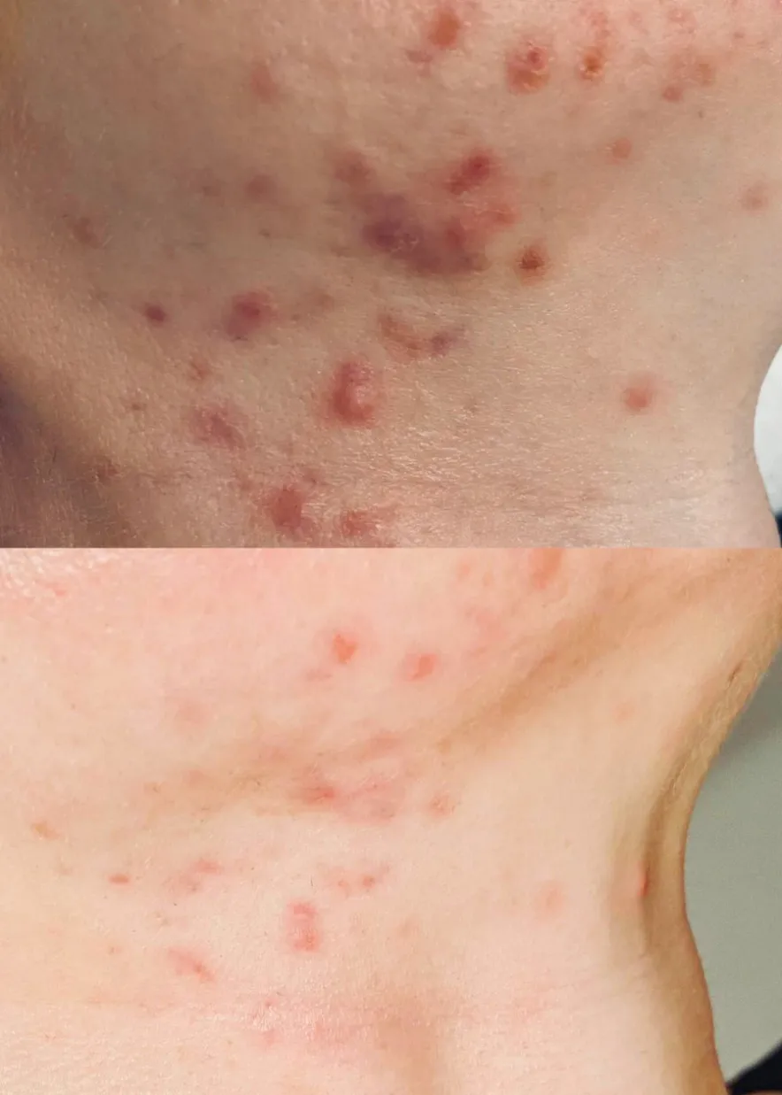 Red Peel Breakout Control Mask